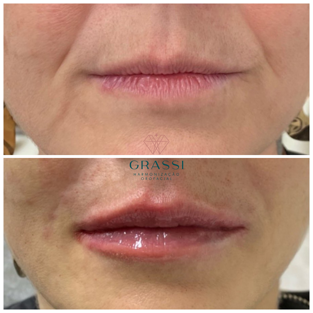 Preenchimento do Sulco Nasolabial (Bigode Chinês) Dra. Rosalia Grassi